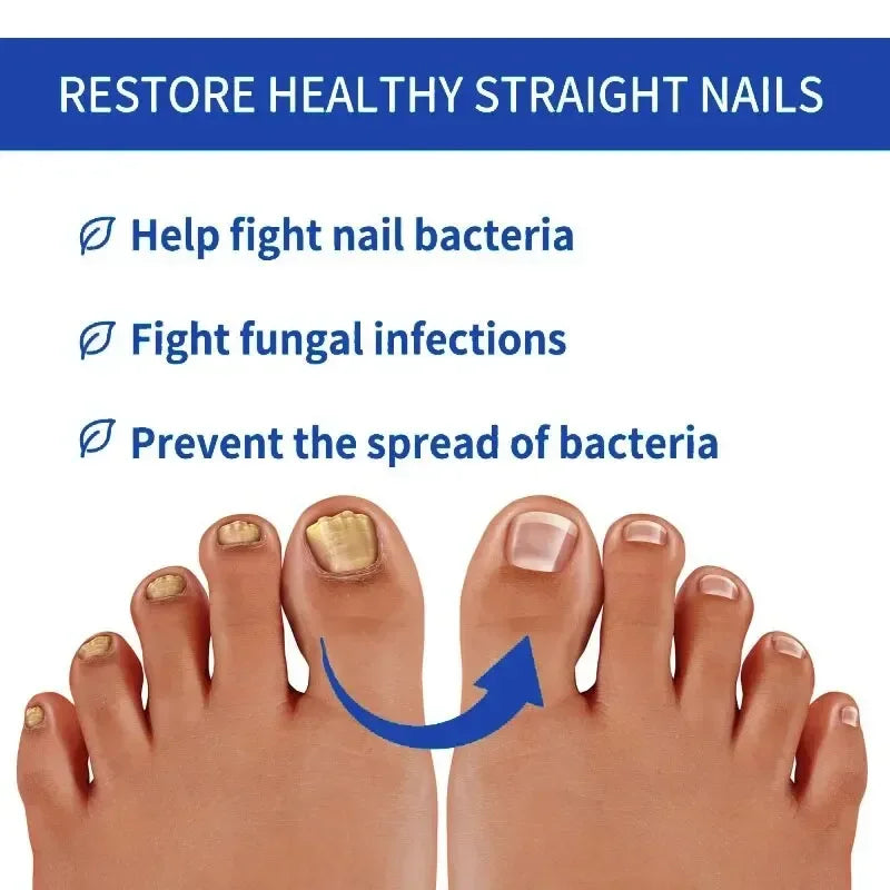 Fungal Nail Treatment Removal Oil Foot fungus Repair Essence Toe Fungus Removal Gel Anti Infection best essenice